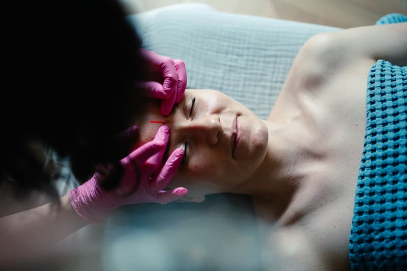 Igłoterapia Estetyczna i Pinezkowanie: Skuteczny Sposób na Młodszy Wygląd miniatura 3