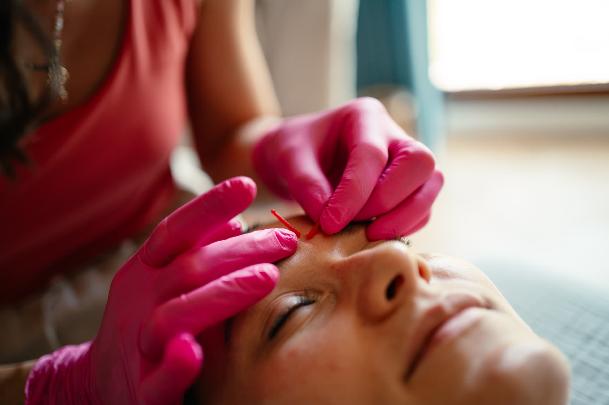 Igłoterapia Estetyczna i Pinezkowanie: Skuteczny Sposób na Młodszy Wygląd miniatura 5