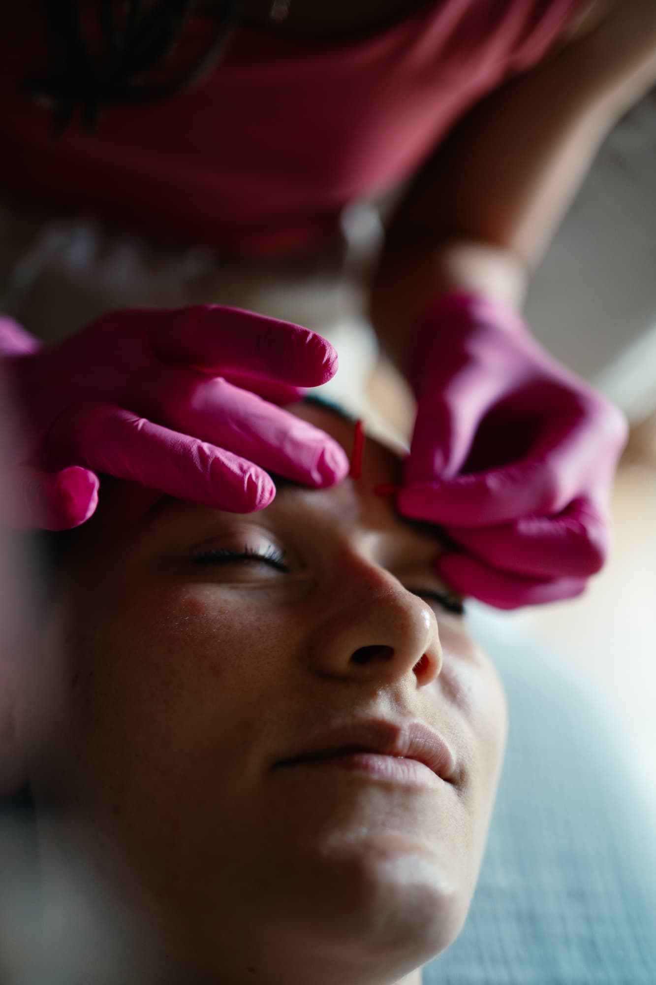 Igłoterapia Estetyczna i Pinezkowanie: Skuteczny Sposób na Młodszy Wygląd miniatura 4