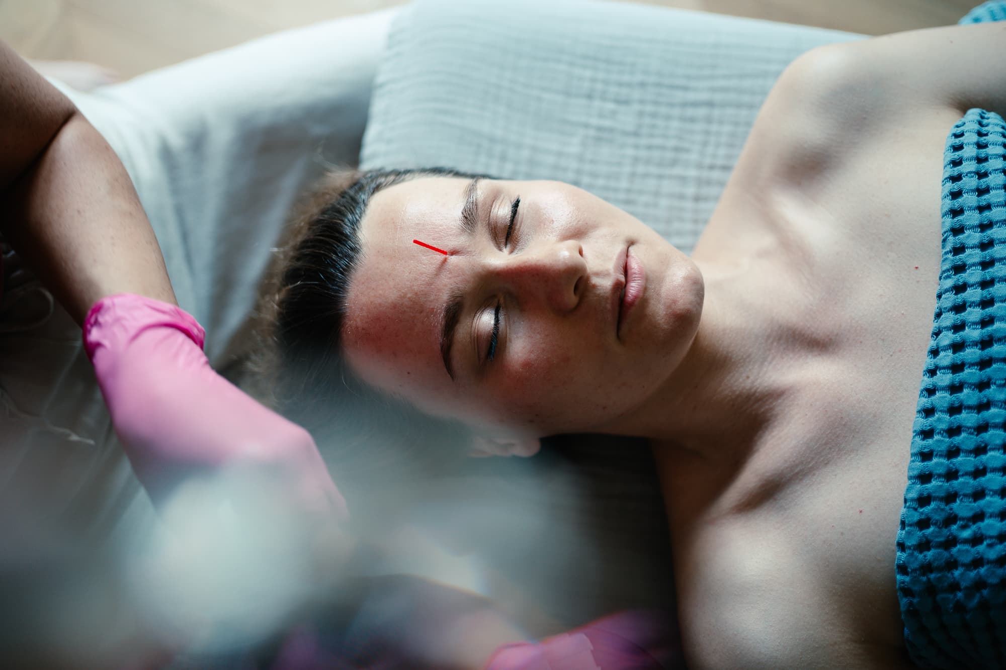 Igłoterapia Estetyczna i Pinezkowanie: Skuteczny Sposób na Młodszy Wygląd - miniatura 6